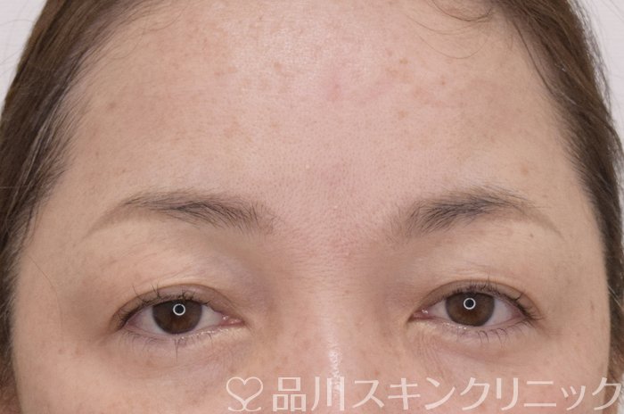 症例NO.73993のBEFORE写真