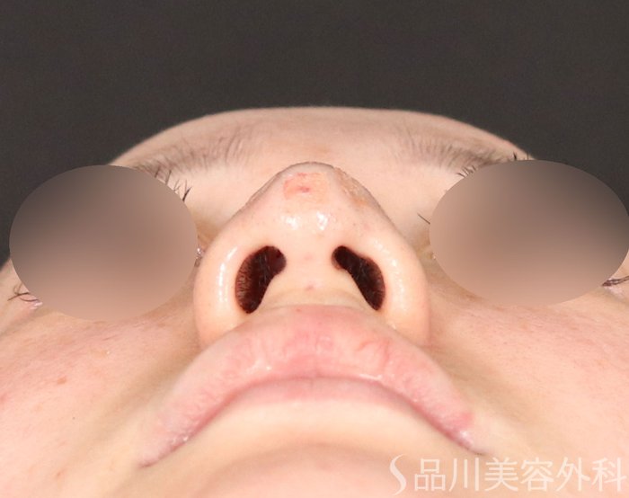 症例NO.71880のAFTER写真