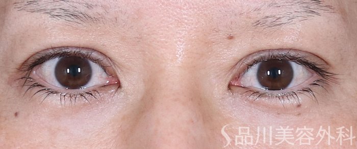 症例NO.72401のAFTER写真