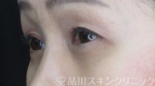 症例NO.68731のAFTER写真