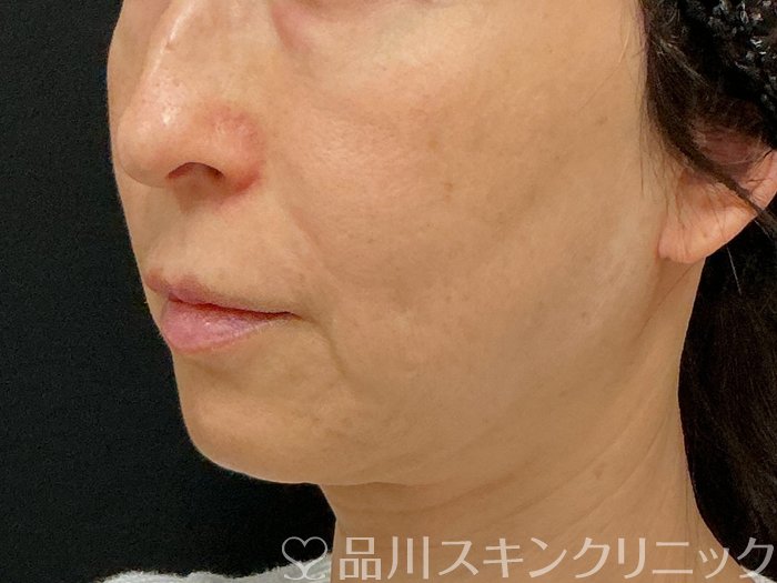 症例NO.74819のBEFORE写真