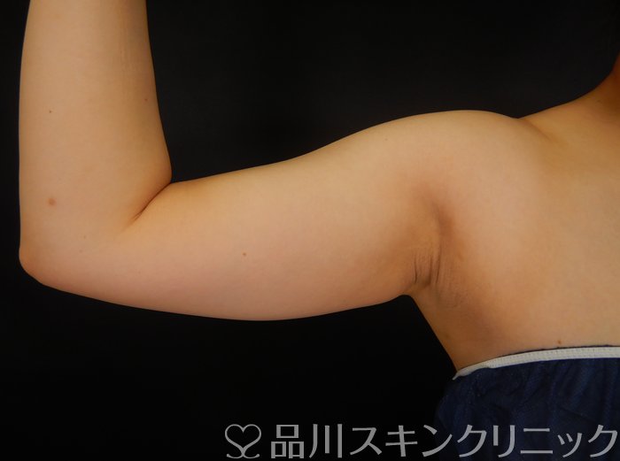 症例NO.66755のAFTER写真