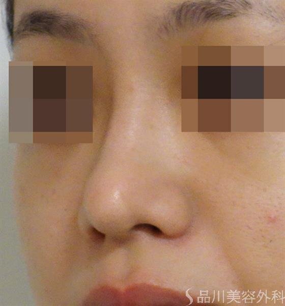 症例NO.42764のAFTER写真