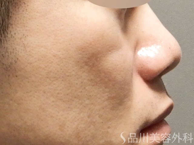 症例NO.68052のBEFORE写真