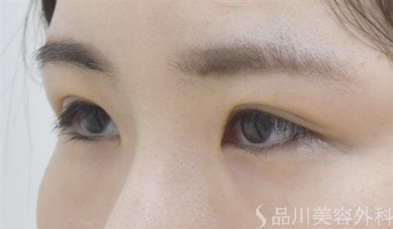 症例NO.54040のAFTER写真