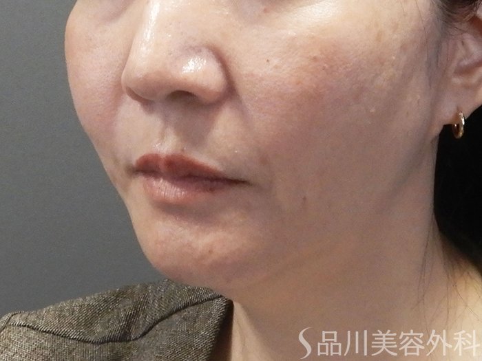 症例NO.72530のBEFORE写真