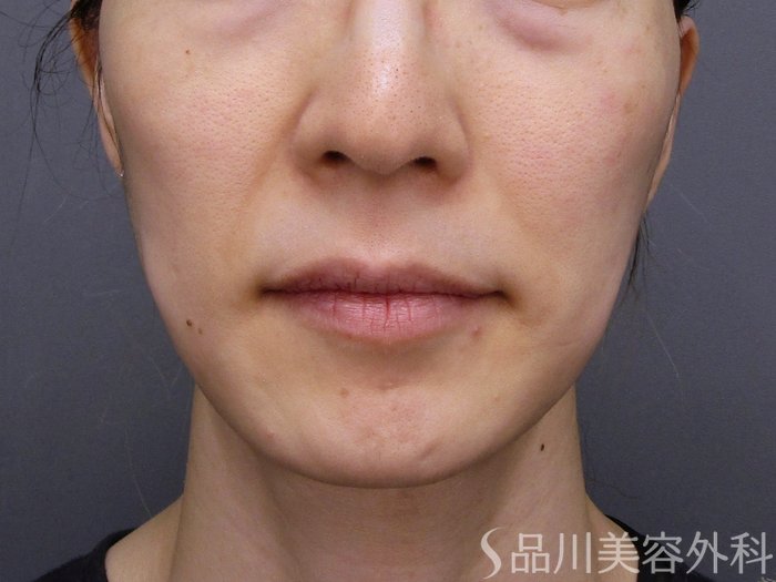 症例NO.75128のBEFORE写真
