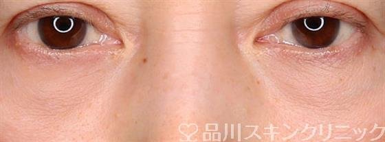 症例NO.59170のAFTER写真