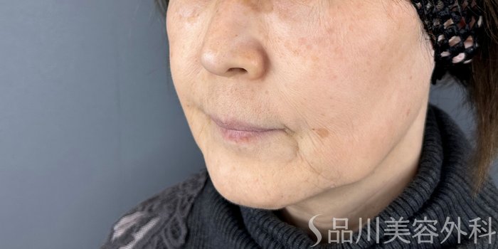 症例NO.72570のBEFORE写真