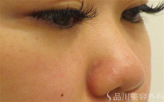 症例NO.57056のBEFORE写真
