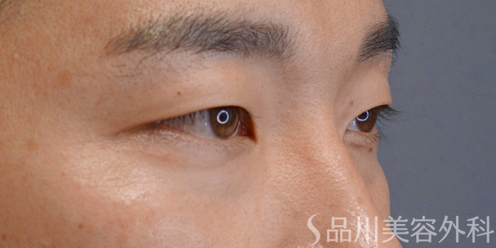 症例NO.74204のBEFORE写真