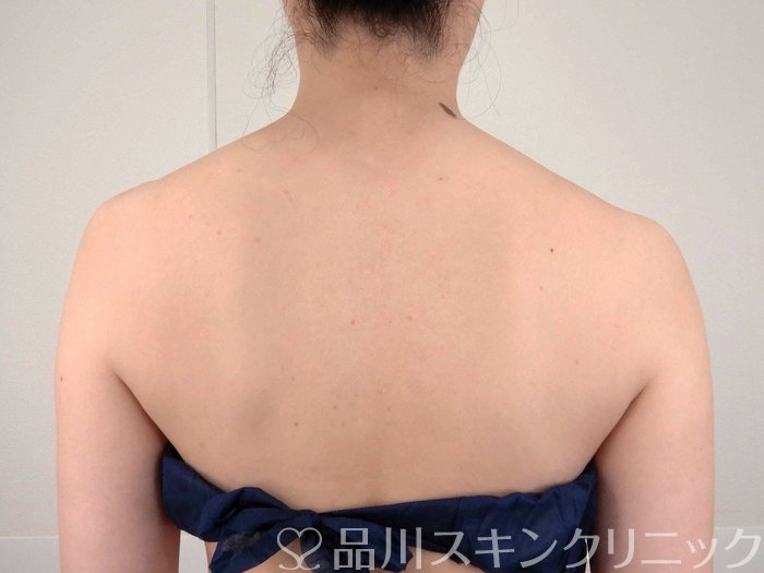 症例NO.62189のBEFORE写真