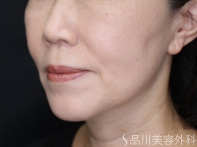 症例NO.72315のAFTER写真