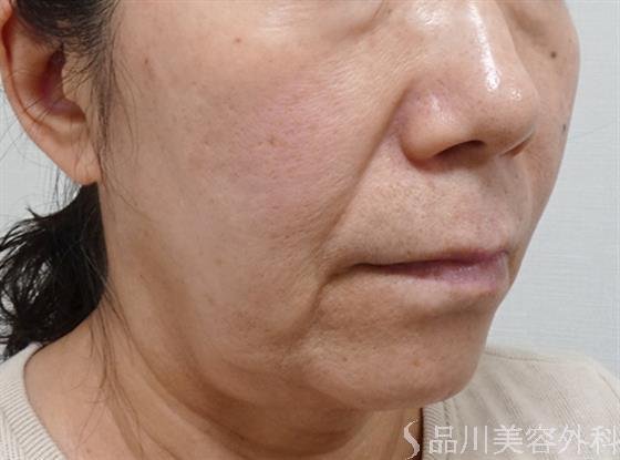 症例NO.53641のBEFORE写真