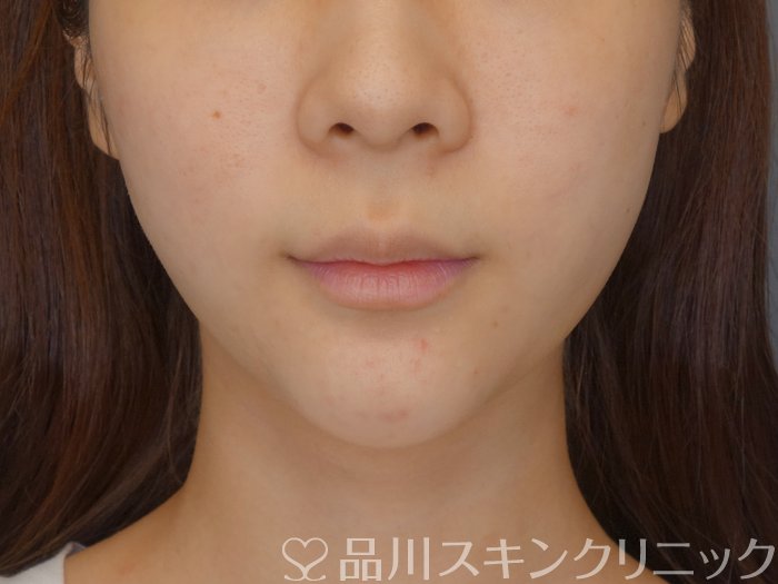 症例NO.71811のBEFORE写真