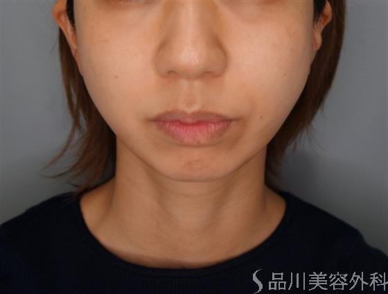 症例NO.54720のBEFORE写真