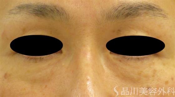 症例NO.47822のBEFORE写真