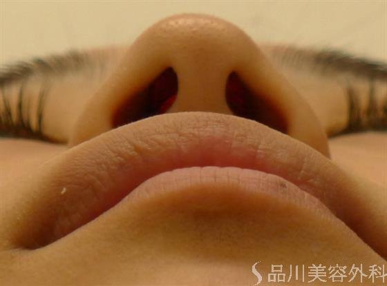 症例NO.39511のBEFORE写真