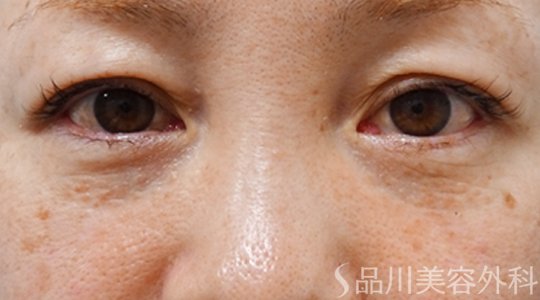症例NO.74141のAFTER写真