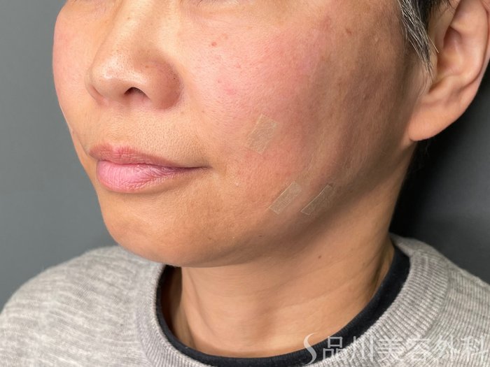 症例NO.74215のAFTER写真