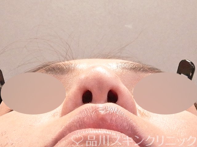 症例NO.67918のAFTER写真