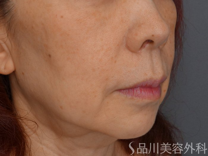 症例NO.73758のBEFORE写真