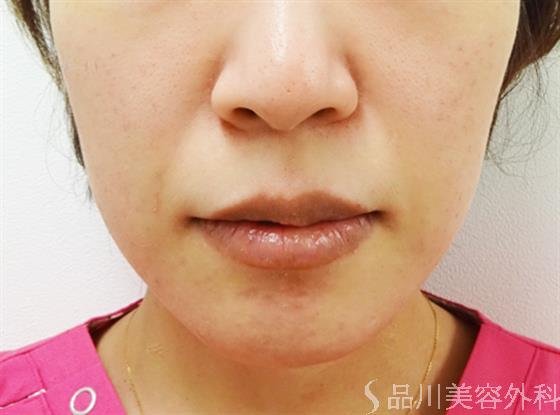症例NO.32826のBEFORE写真