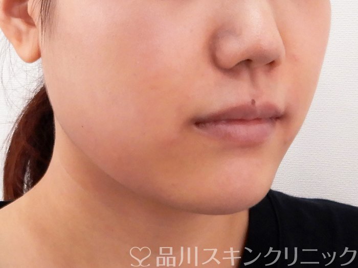 症例NO.63696のAFTER写真