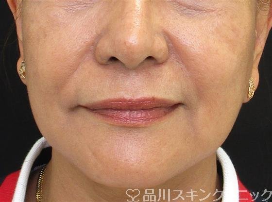 症例NO.56298のBEFORE写真