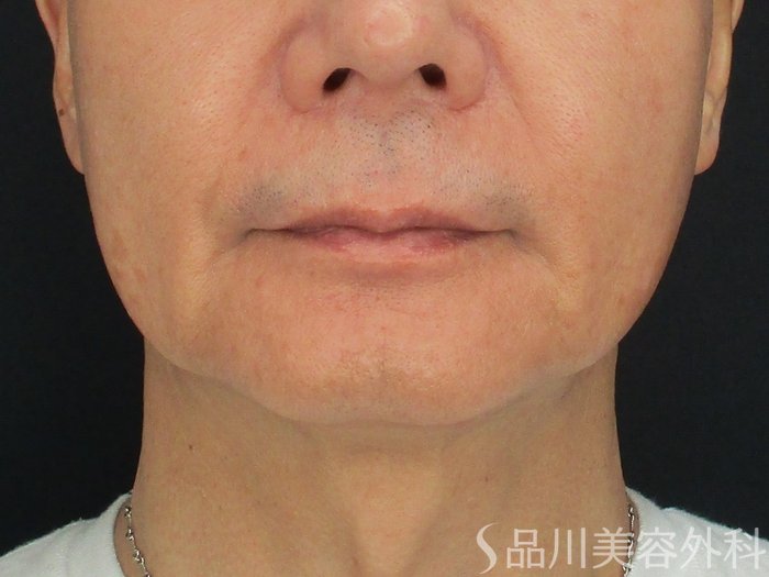 症例NO.69495のBEFORE写真