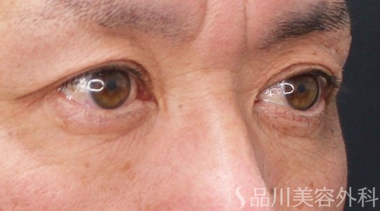 症例NO.69863のBEFORE写真