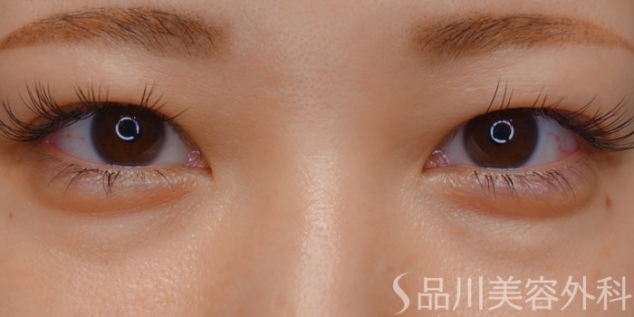 症例NO.62412のBEFORE写真