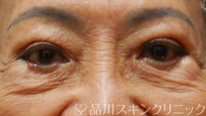 症例NO.68404のBEFORE写真