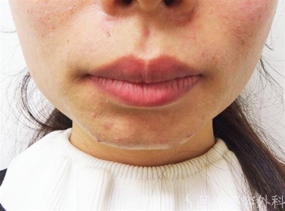 症例NO.33010のBEFORE写真