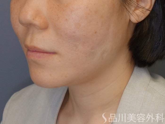 症例NO.70359のAFTER写真