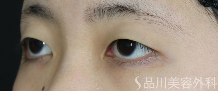 症例NO.72087のBEFORE写真