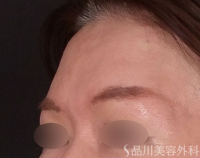 症例NO.70526のAFTER写真