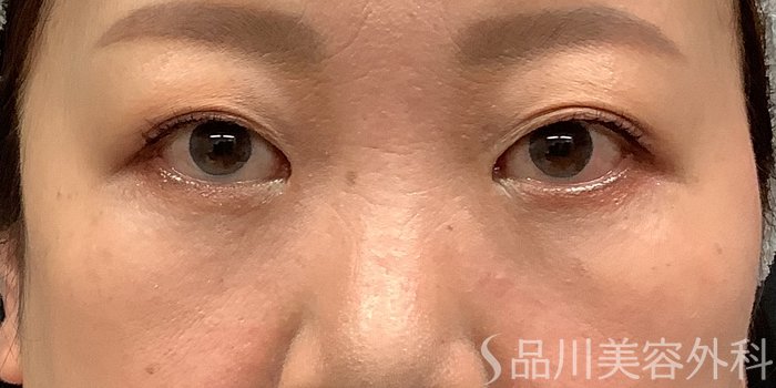 症例NO.71236のAFTER写真