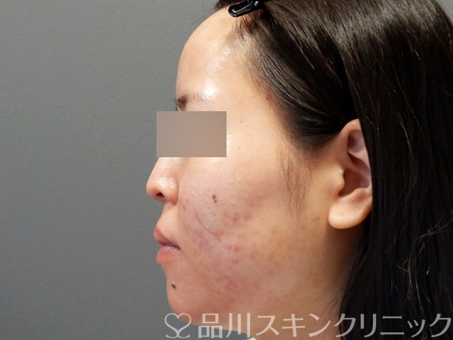 症例NO.71632のAFTER写真