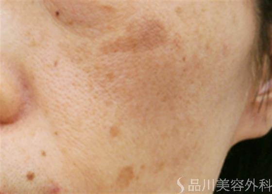 症例NO.24373のBEFORE写真