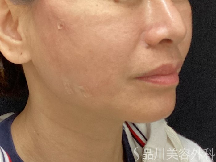 症例NO.69701のAFTER写真