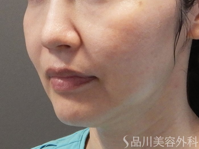症例NO.69175のBEFORE写真