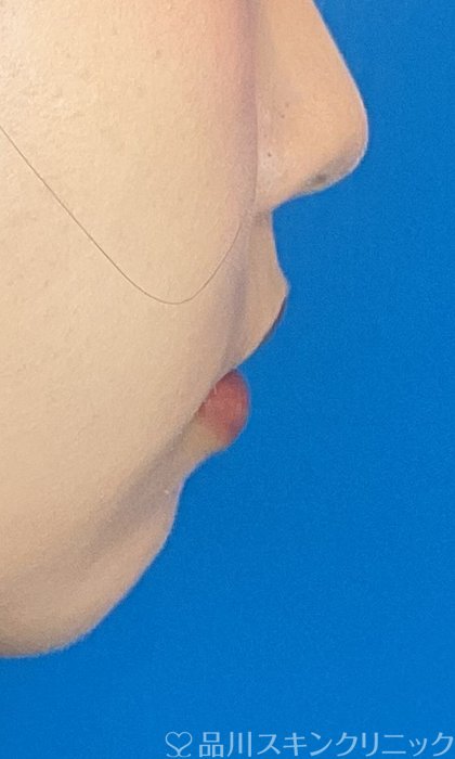 症例NO.74487のBEFORE写真