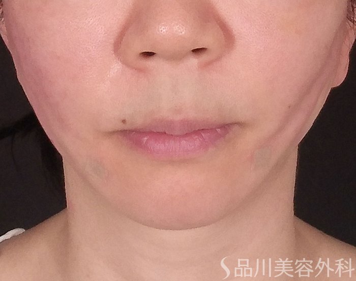 症例NO.70451のAFTER写真