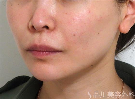 症例NO.35709のAFTER写真