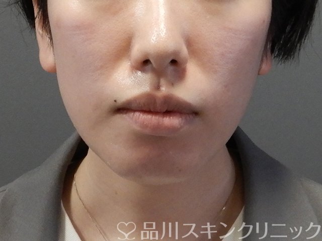 症例NO.64460のBEFORE写真