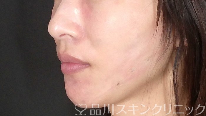 症例NO.71980のAFTER写真