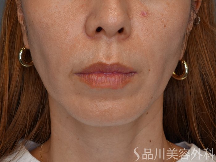 症例NO.72119のBEFORE写真