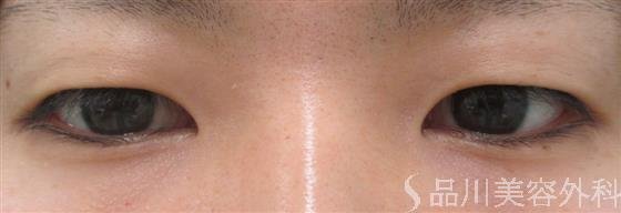 症例NO.23016のBEFORE写真