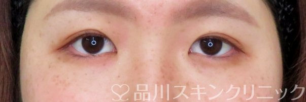 症例NO.74143のAFTER写真